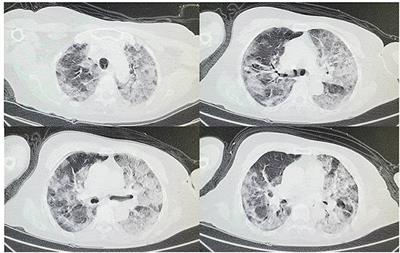 A Case of Coronavirus Disease 2019 With Concomitant Acute Cerebral Infarction and Deep Vein Thrombosis